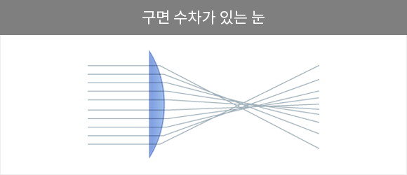 비구면 수술