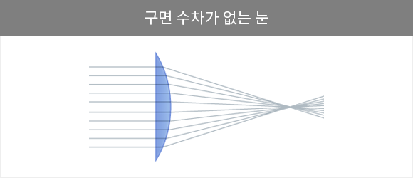 비구면 수술