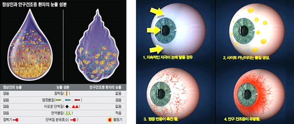 안구건조증