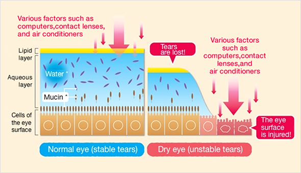 안구건조증의 원인