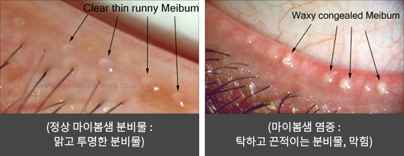 안구건조증 치료