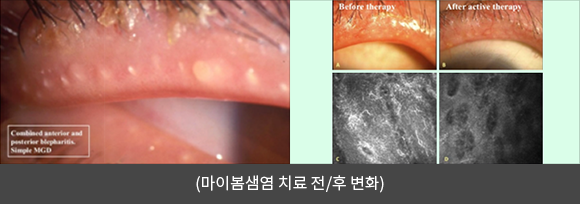 안구건조증 치료