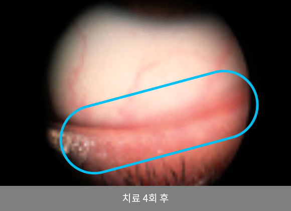 M22 IPL레이저 시술 전/후