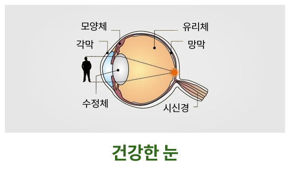 노안이란