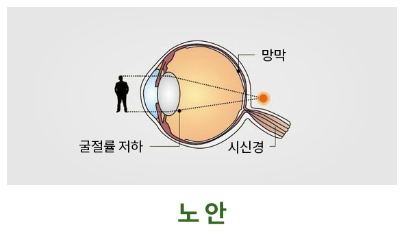 노안이란