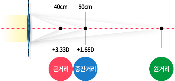 LBV 노안 교정 수술