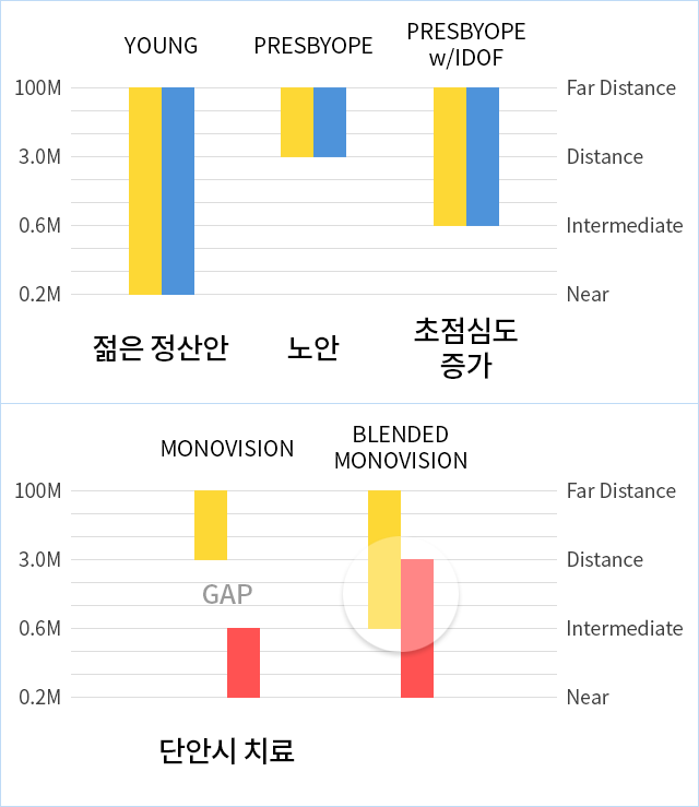 LBV 노안 교정 수술의 원리