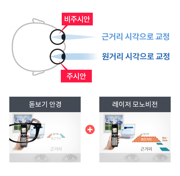 레이저 노안 라섹 수술 방법