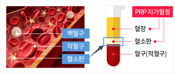 자가혈청 안약