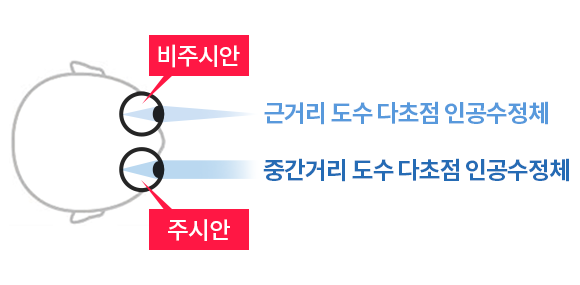 개인맞춤 노안 다초점 렌즈삽입술