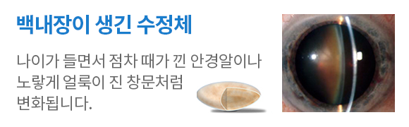 백내장이 생긴 수정체