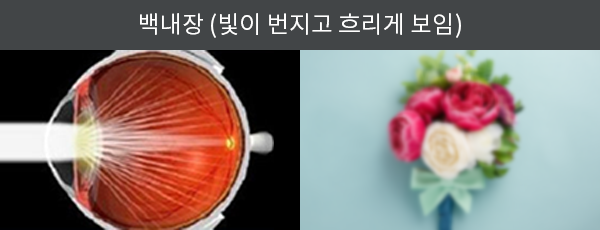 백내장의 원인